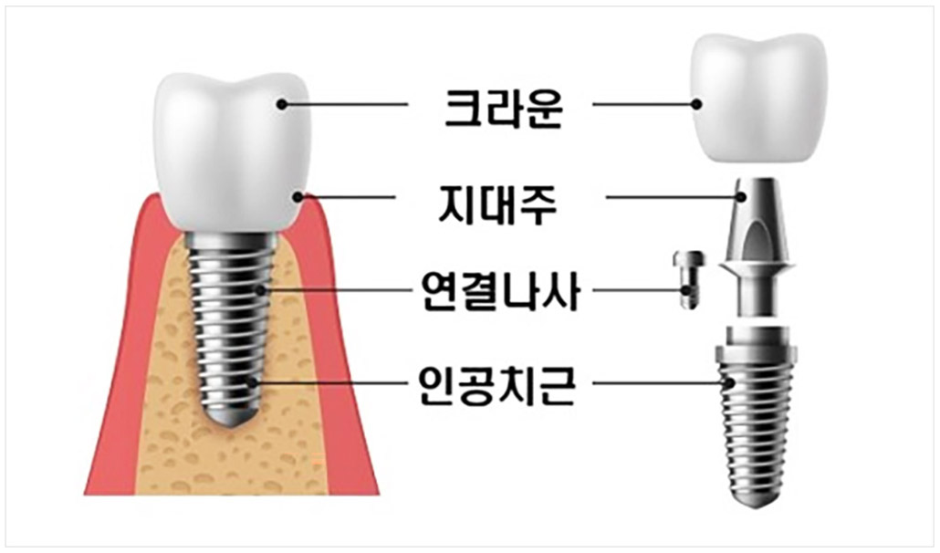 임플란트 구조.jpg