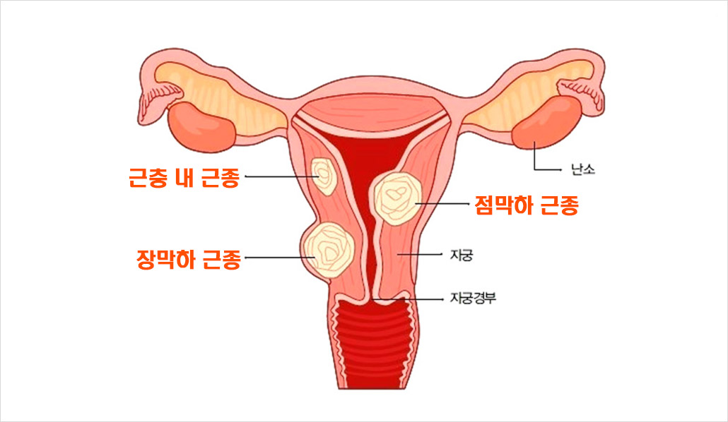 자궁근종 종류.jpg