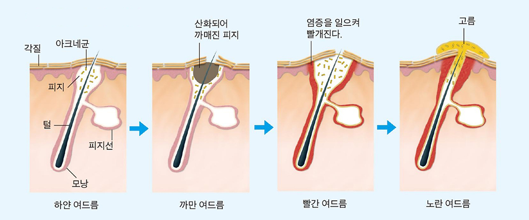 여드름 진행단계.jpg