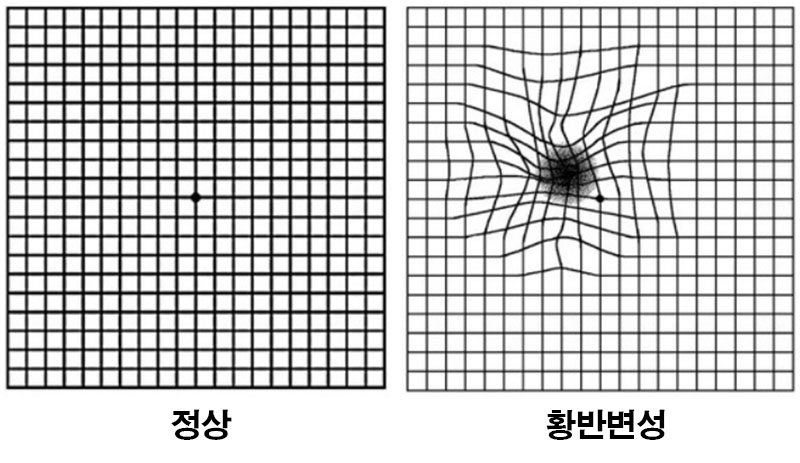 황반변성 증상.jpg