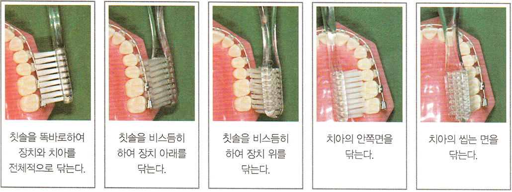 치아교정 어금니 칫솔질.jpg