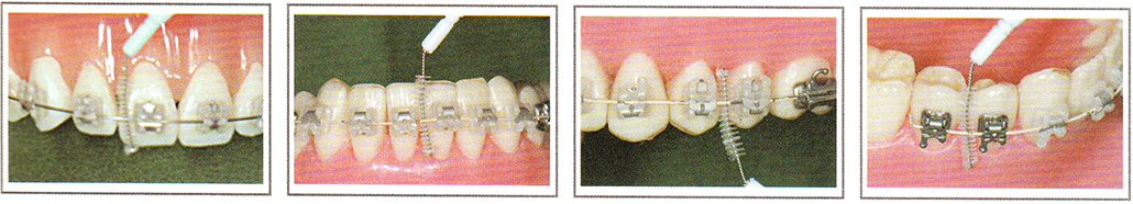 치아교정 치간칫솔.jpg