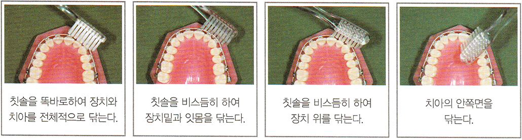 치아교정 앞니 칫솔질.jpg