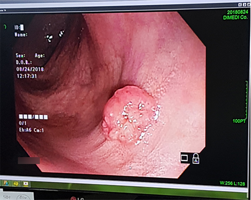 대장내시경 선종.png
