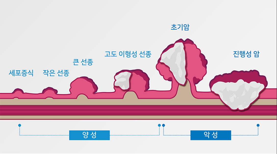 대장암 진행단계.png