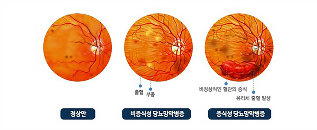 당뇨망막병증.jpg