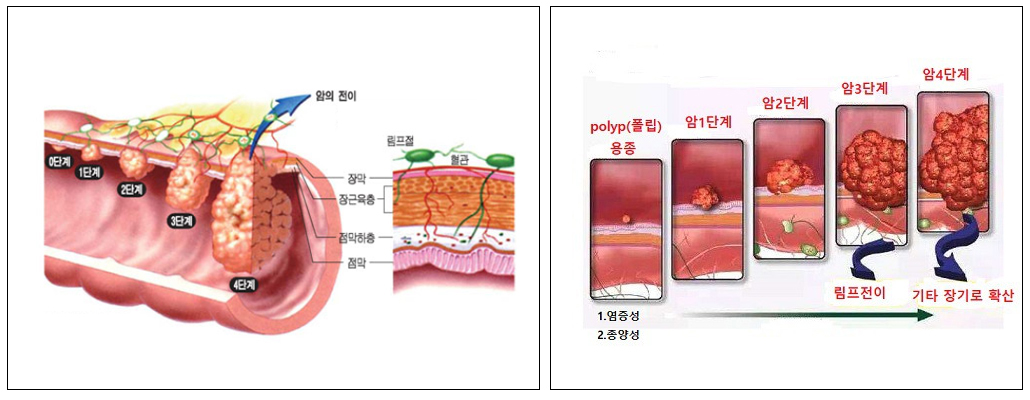 대장암 진행단계.jpg