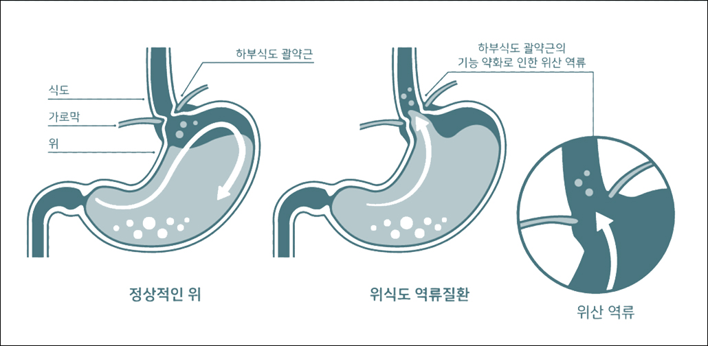 위식도역류질환.jpg