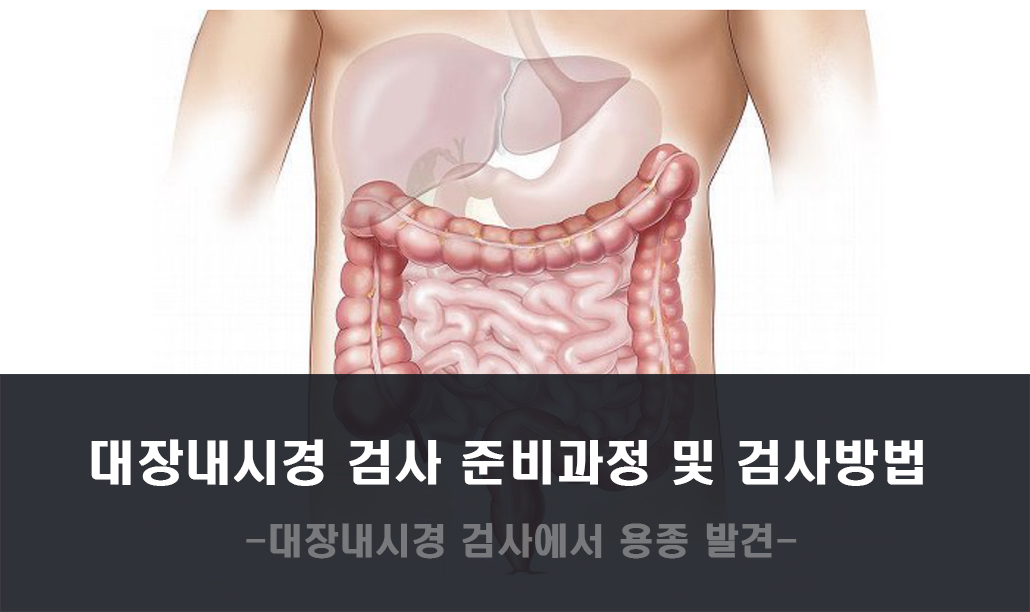 대장내시경.jpg