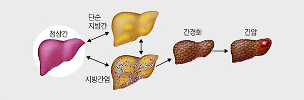 지방간 합병증.jpg