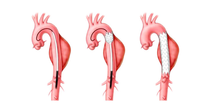 대동맥류 실란트 그라프트.jpg