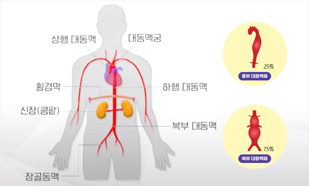 대동맥류 혈관건강.jpg