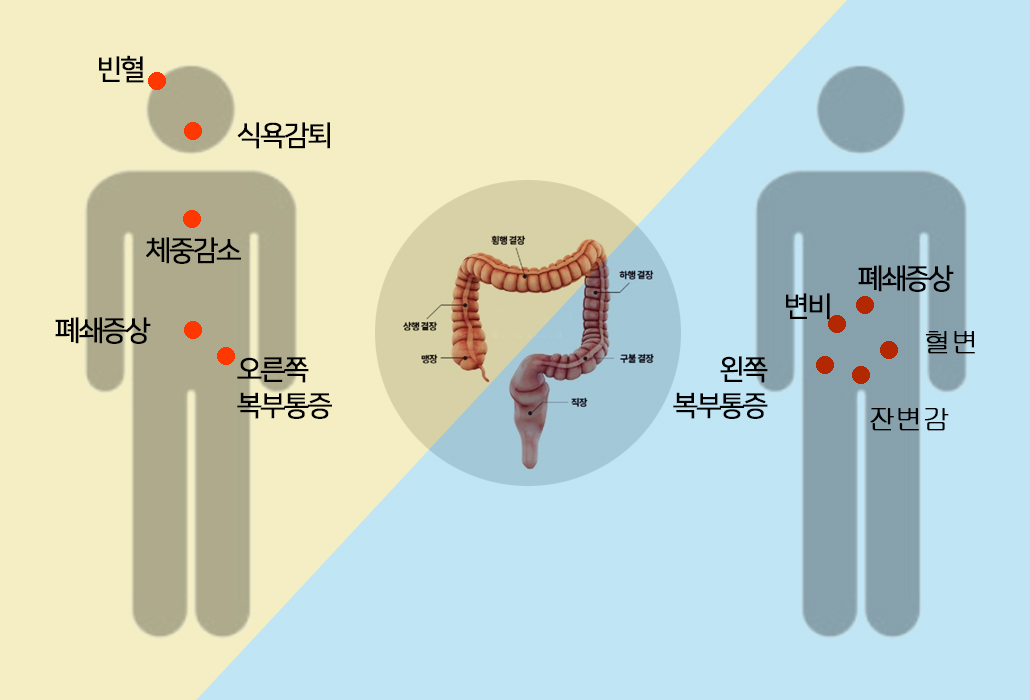 대장암 증상.jpg