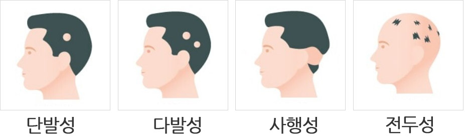 원형탈모 종류.jpg