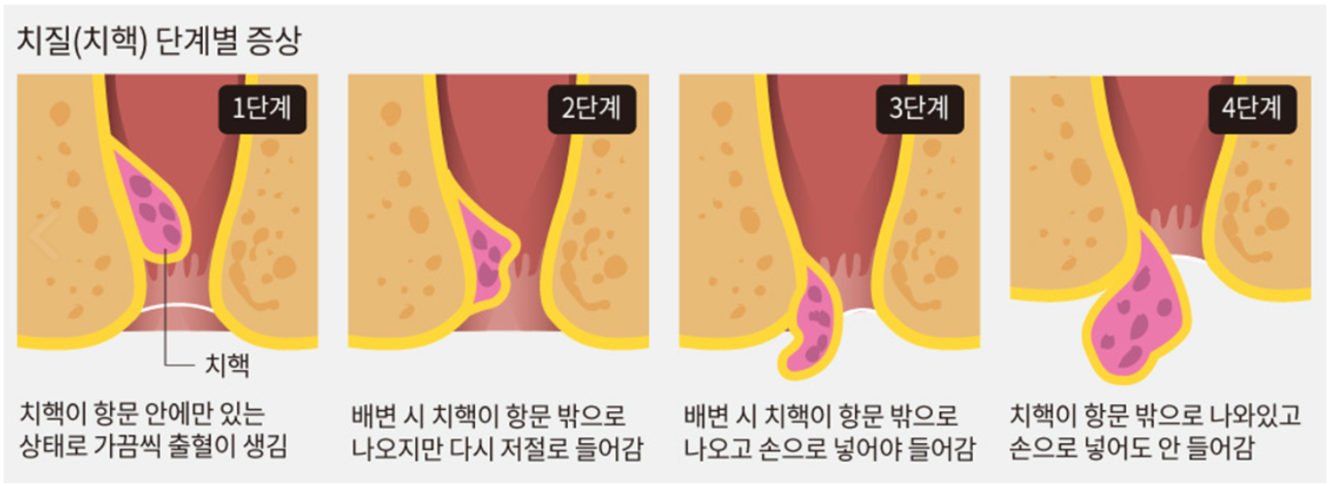 치질(치핵)의 단계.png