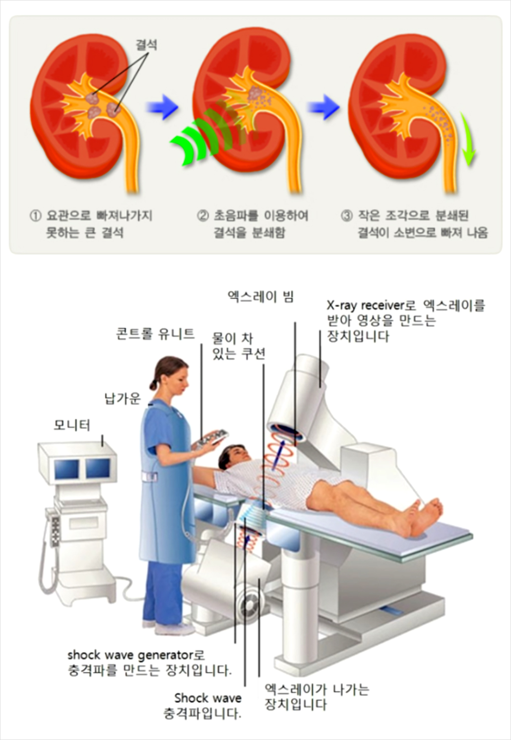 요로결석 체외충격파쇄석술.jpg