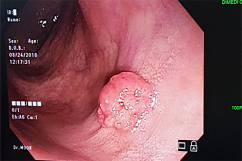 대장내시경 용종
