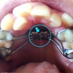 [치아교정 후기②] 악궁확장장치 부착방법 및 주의사항