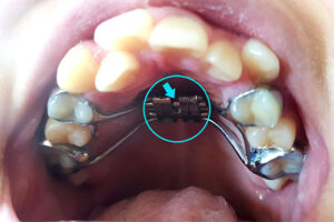 [치아교정 후기②] 악궁확장장치 부착방법 및 주의사항