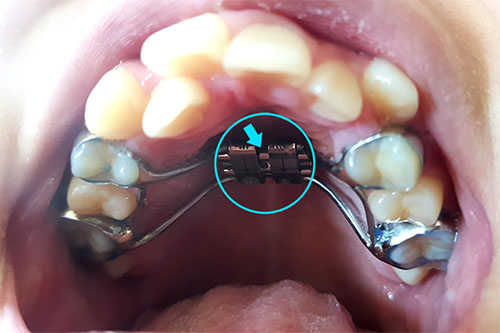 치아교정 악궁확장장치