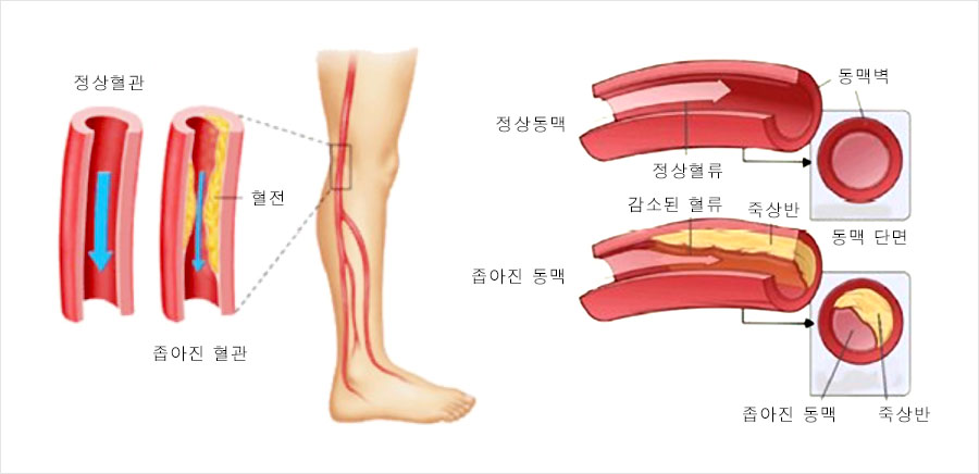 말초동맥 질환 혈액순환